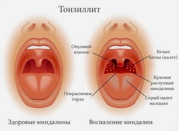 Азитромицин детский. Инструкция по применению таблетки, суспензия, капсулы. Цена, аналоги