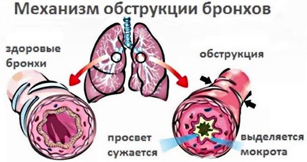 Обструктивный бронхит у ребенка карта вызова