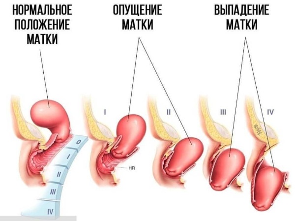 Частые позывы к мочеиспусканию у женщин. Причины и лечение без боли, ложные, резкие, ночные, болезненные перед месячными, после родов