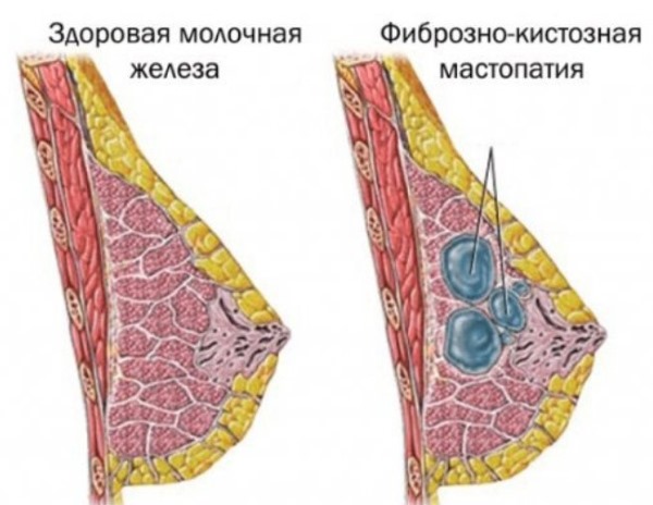 Чем лечить мастопатию у женщин после 30, 40, 50 лет. Мази, антибиотики, народные средства, таблетки, витамины