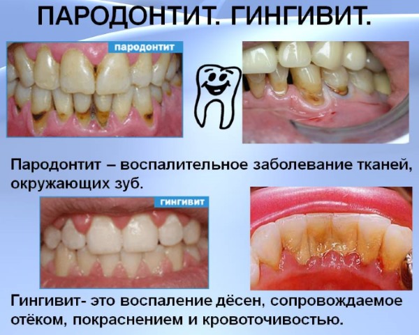 Чем лечить воспаление десен, причины. Мази, антибиотики, полоскание, таблетки, гель, травы