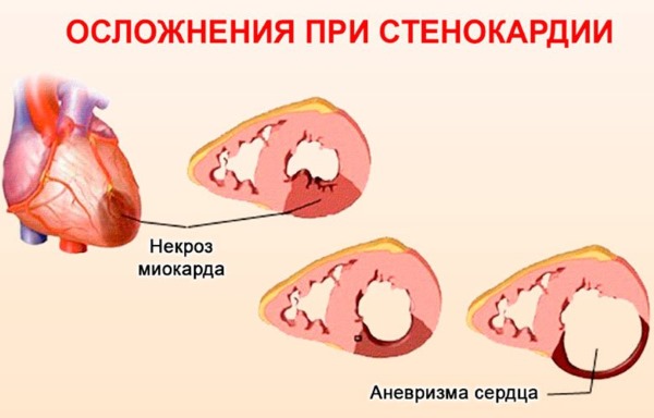 Стенокардия фото для презентации