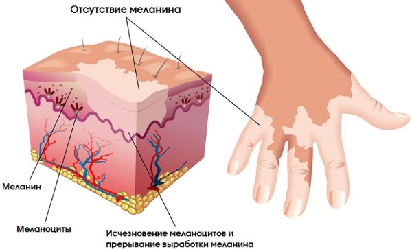 Детские болезни с высыпаниями на коже и лице, с и без температуры. Фото, признаки