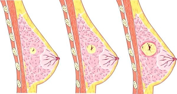 Диффузная мастопатия молочных желез: что это, симптомы фиброзно-кистозная, смешанная. Лечение народными средствами