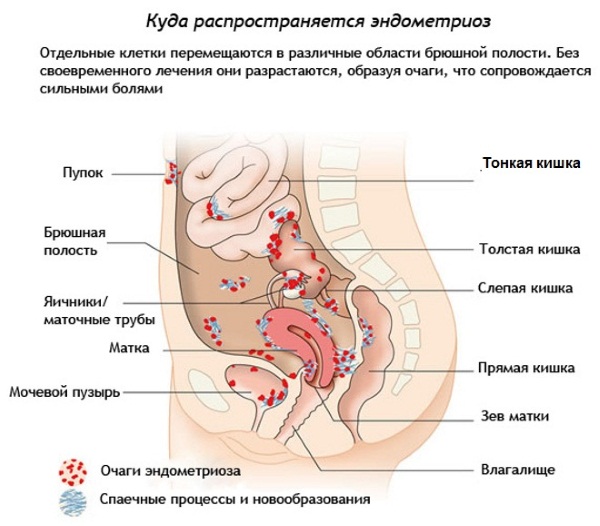 Эндометриоз. Симптомы и лечение у женщин народными средствами, травами, гормональными препаратами, гомеопатией, таблетки, свечи. Признаки, причины, прогноз