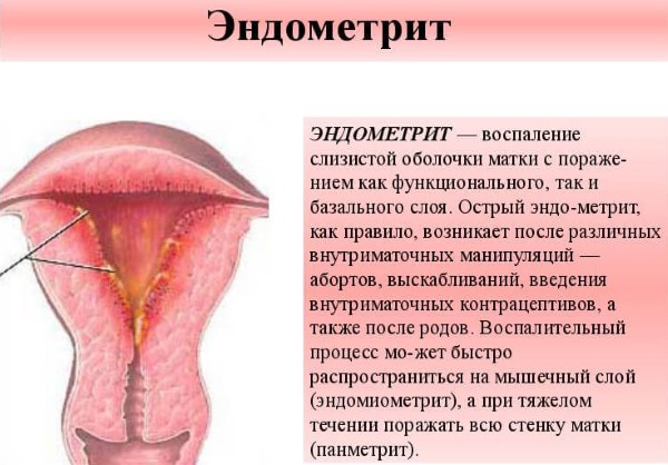 Эндометрит. Симптомы и лечение у женщин. Хронический, острый, подострый, неспецифический, аутоиммунный, неактивный. Схема лечения, физиотерапия, свечи