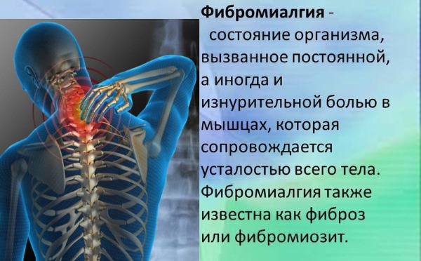 Фибромиалгия. Что это такое, как лечить, симптомы, причины. Народные средства, препараты, какой врач лечит