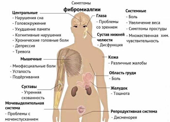 Фибромиалгия. Что это такое, как лечить, симптомы, причины. Народные средства, препараты, какой врач лечит