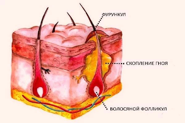 Фурункулез. Причины и лечение народными средствами, препараты, антибиотики в домашних условиях. Обследование, как избавиться