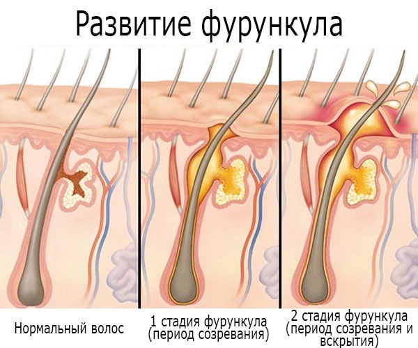 Фурункулез. Причины и лечение народными средствами, препараты, антибиотики в домашних условиях. Обследование, как избавиться