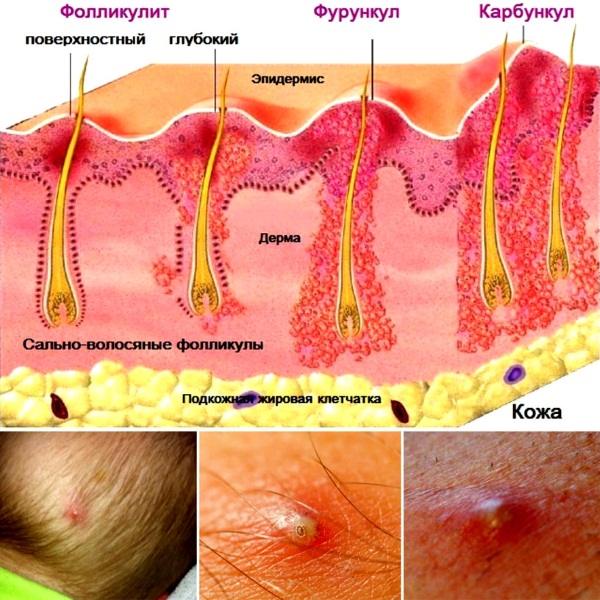 Фурункулез. Причины и лечение народными средствами, препараты, антибиотики в домашних условиях. Обследование, как избавиться