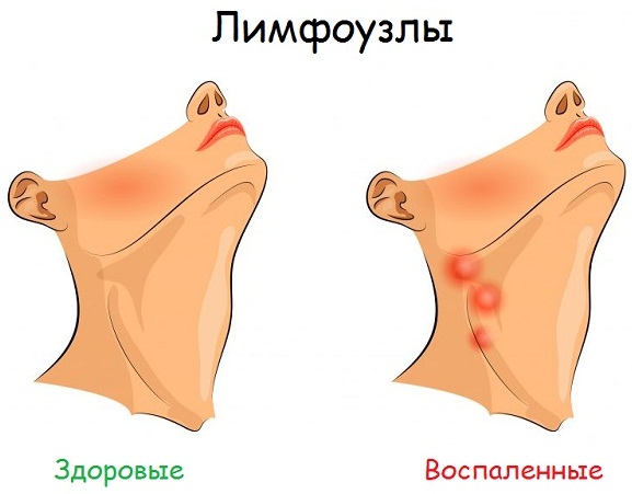 Фурункулез. Причины и лечение народными средствами, препараты, антибиотики в домашних условиях. Обследование, как избавиться