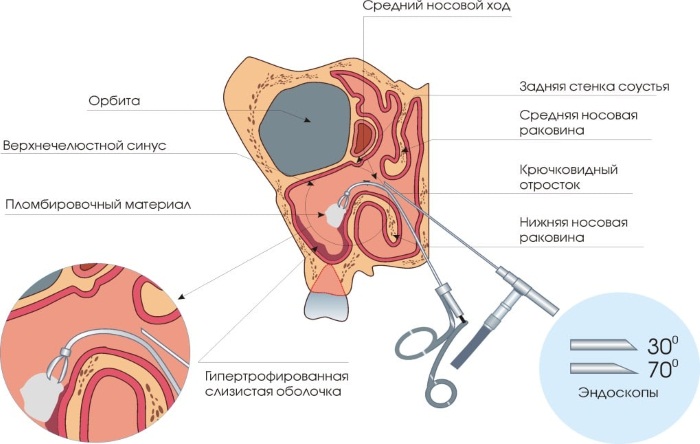 Гайморит. Симптомы и лечение у взрослых народными средствами, антибиотиками, капли