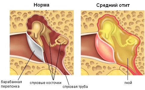 Гайморит. Симптомы и лечение у взрослых народными средствами, антибиотиками, капли