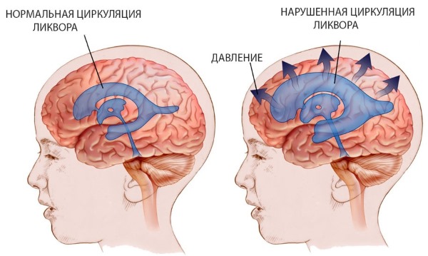 Гидроцефалия головного мозга у новорожденных. Что такое умеренная, заместительная, смешанная, наружная. Симптомы и лечение народными средствами, препараты