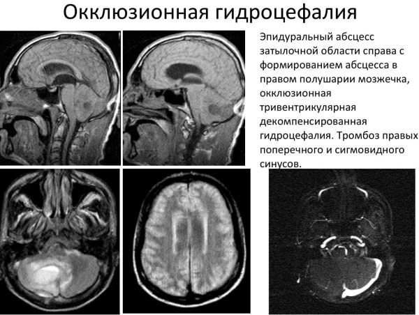 Гидроцефалия на фоне кортикальной атрофии