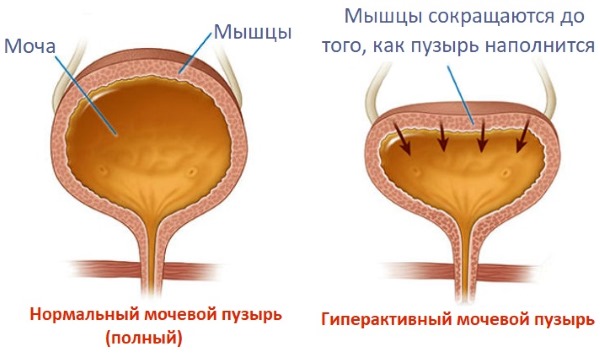 Гиперактивный мочевой пузырь у женщин. Лечение народными средствами, препараты, лекарства, таблетками. Симптомы, признаки, причины