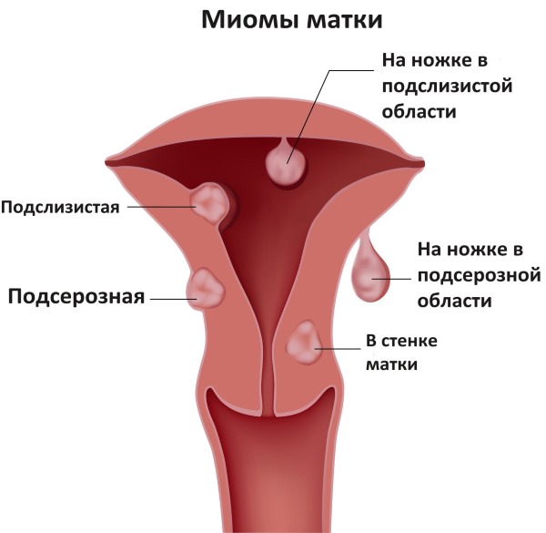 Гиперплазия эндометрия в менопаузе: железистая, очаговая, атипическая, простая, сложная. Что это, признаки, лечение