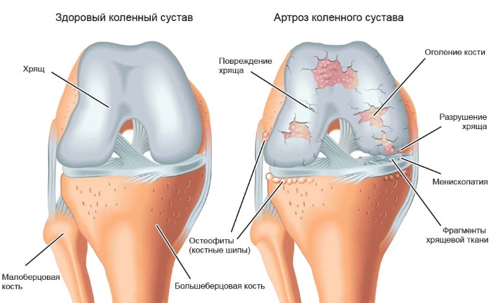 Гонартроз 2 степени коленного сустава. Лечение народными средствами, уколы, гимнастика по Бубновскому. Начальные признаки, группа инвалидности