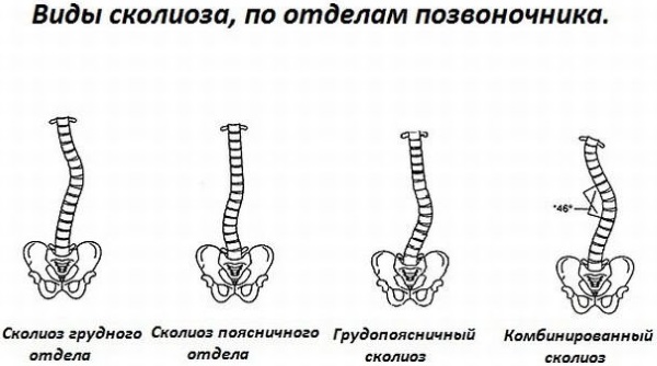 Искривление позвоночника у подростка фото