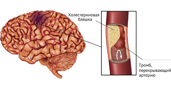 Как болит сердце. Симптомы у женщин, признаки, причины. Чем лечить при климаксе, остеохондрозе, пролапсе митрального клапана, инфаркте, ВСД, неврозе, стрессе