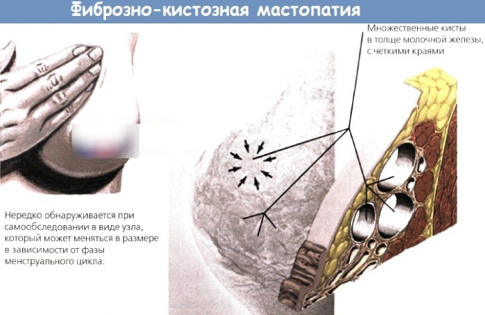 Кистозно-фиброзная мастопатия. Что это, чем опасна, причины, симптомы, лечение. Народные средства, препараты