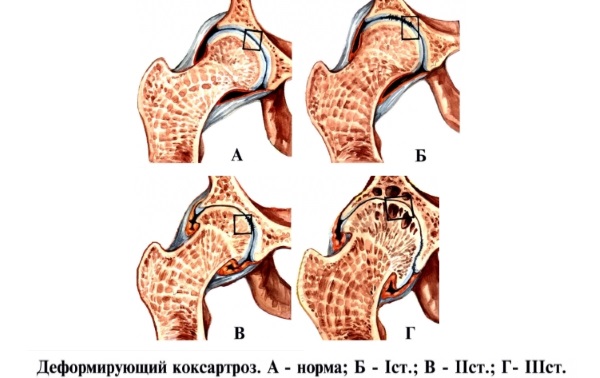 Коксартроз тазобедренного сустава. Симптомы и лечение. Хондропротекторы, ЛФК, диета, массаж