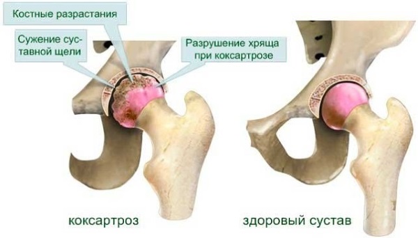 Коксартроз тазобедренного сустава. Симптомы и лечение. Хондропротекторы, ЛФК, диета, массаж