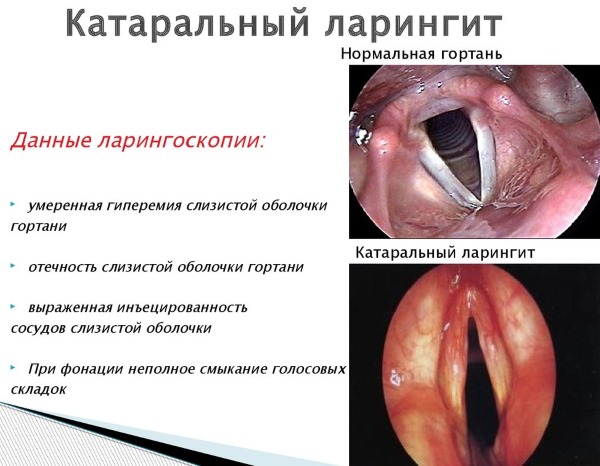 Ларингит у детей: острый, вирусный. Симптомы, первая помощь, лечение: препараты, сиропы, ингаляции