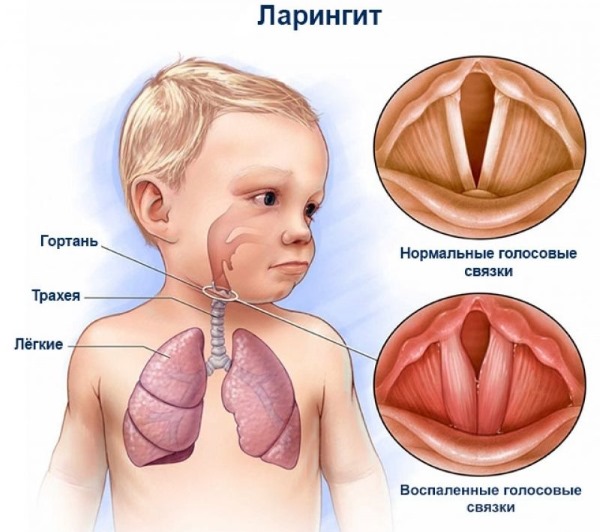 Ларингит у детей: острый, вирусный. Симптомы, первая помощь, лечение: препараты, сиропы, ингаляции