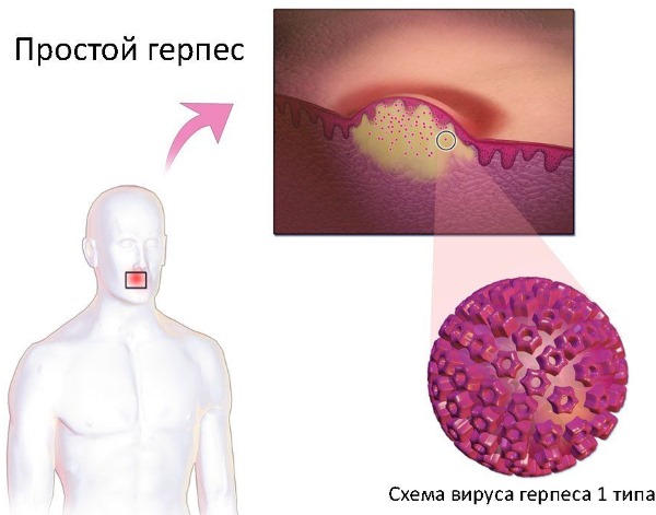 Лечение герпеса на губах. Мази, препараты в таблетках, народные средства. Как лечить в домашних условиях, при беременности