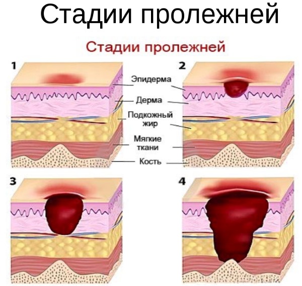 Лечение пролежней в домашних условиях. Обработка народными средствами, лекарства для лежачих больных