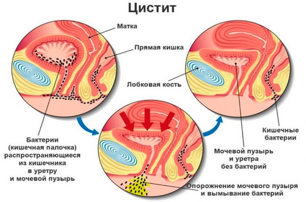 Лечение цистита у женщин. Препараты в таблетках, на травах, уколы, народные средства, быстродействующие лекарства