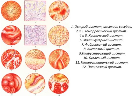 Хронический цистит лечение у женщин препараты схема