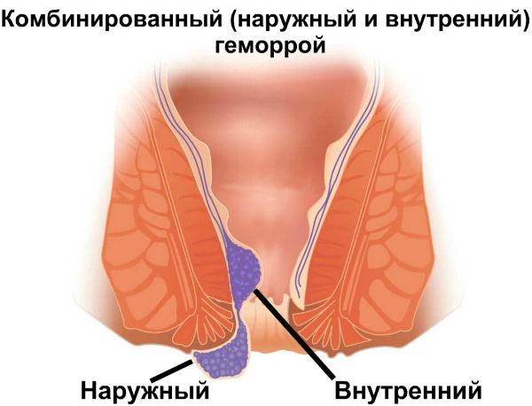 Левомеколь мазь. От чего помогает в гинекологии, урологии, проктологии, стоматологии. Инструкция по применению. Цена, аналоги, отзывы