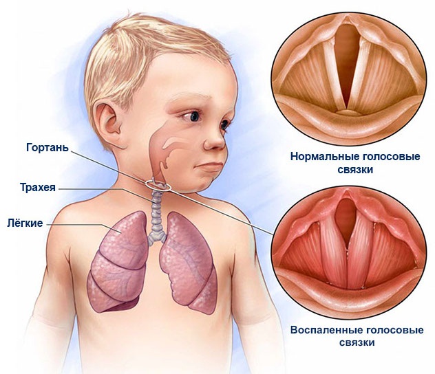 Ложный круп у детей. Симптомы и лечение народными средствами, ингаляции, антибиотики в домашних условиях. Причины возникновения, неотложная помощь
