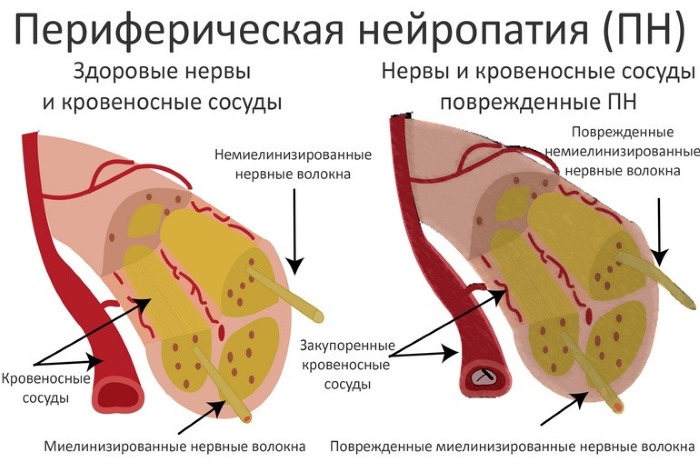 Метрогил. Раствор для внутривенного введения. Инструкция по применению, показания, цена, отзывы, аналоги