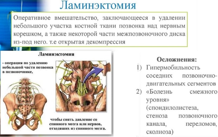 Межпозвоночная грыжа поясничного отдела. Симптомы и лечение. Гимнастика, массаж, удаление, последствия