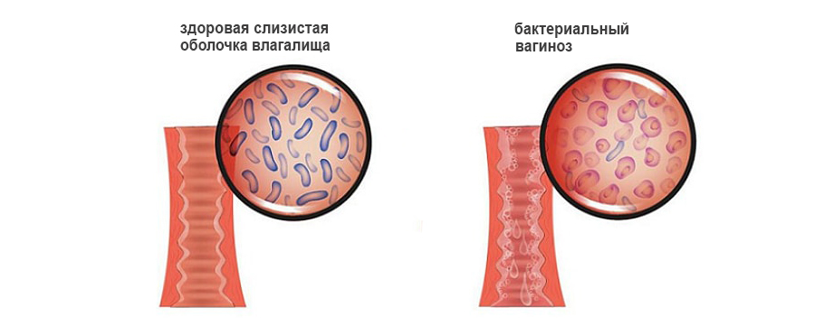 Микоплазмоз у женщин. Симптомы и лечение антибиотиками, народными средствами, свечи. Что это, причины появления, последствия