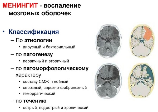 Минингитовая инфекция. Симптомы у взрослых, как передается, инкубационный период, лечение, последствия