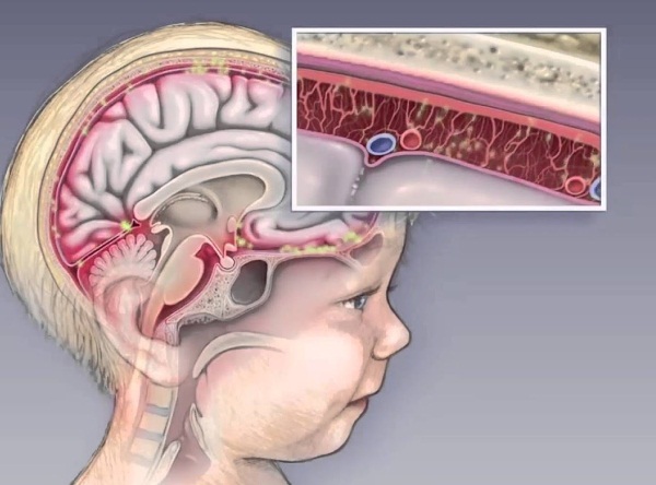 Менингитовая инфекция. Симптомы у детей, как проявляется вирусный, серозный, инкубационный период, последствия. Диагностика, как лечить