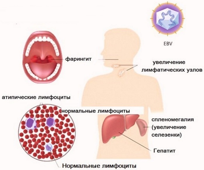 Мононуклеоз. Симптомы и лечение у взрослых: инфекционный, хронический, атипичный. Чем опасен, как передается, последствия