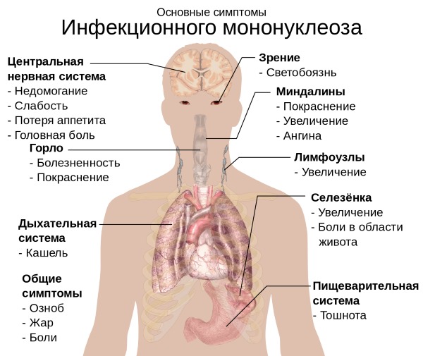 Мононуклеоз. Симптомы и лечение у взрослых: инфекционный, хронический, атипичный. Чем опасен, как передается, последствия