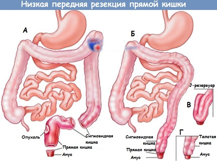 Непроходимость кишечника у взрослых. Причины, симптомы и лечение. Народные средствам препараты, операция