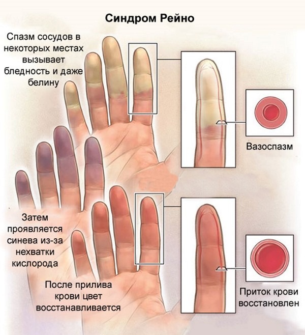 Нейролептики нового поколения без побочных действий. Названия, список препаратов. Цены