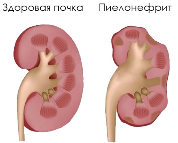 Норма лейкоцитов в анализе мочи у женщин, при беременности. Причины повышенного уровня, лечение