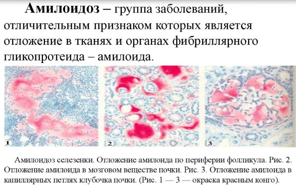 Норма лейкоцитов в анализе мочи у женщин, при беременности. Причины повышенного уровня, лечение