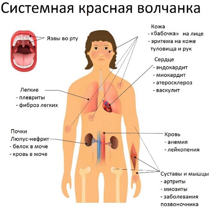 Норма лейкоцитов в анализе мочи у женщин, при беременности. Причины повышенного уровня, лечение