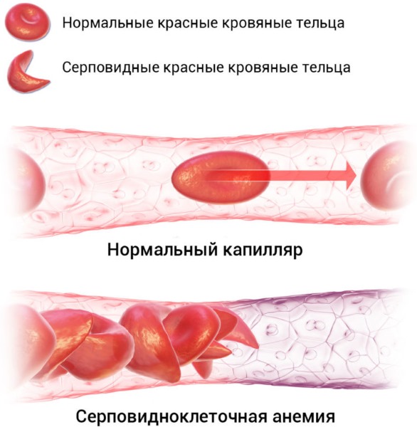 Норма СОЭ в крови у ребенка по Вестергрену, Панченкову. Что значит высокий уровень моноцитов, лейкоцитов