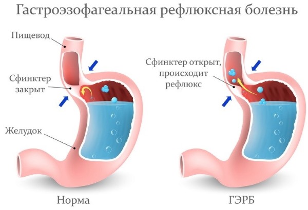 Отрыжка воздухом после еды. Причины и лечение народными средствами, лекарства, если сильная, без запаха, тошнота, ком в горле